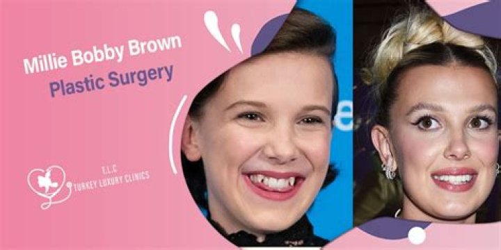 Millie Bobby Brown Plastic Surgery: The Truth Behind Her Transformation